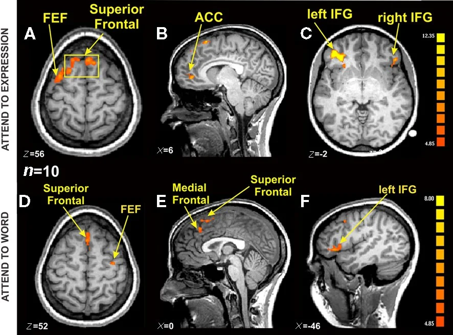 Mapeamento neural por ressonância magnética funcional mostrando áreas ativadas durante processamento cognitivo
